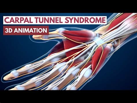 Understanding Carpal Tunnel Syndrome Causes Symptoms And Treatment Schooltube