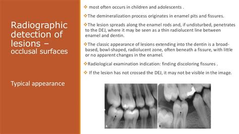 Radiographic Of Interpretation Of Dental Caries