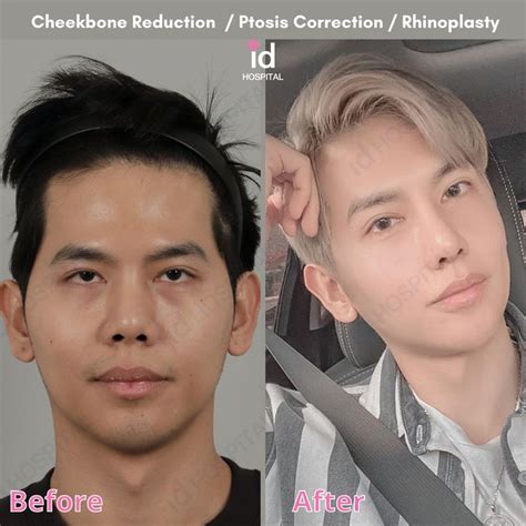 Korean Plastic Surgery Rhinoplasty Before And After Double Eyelid