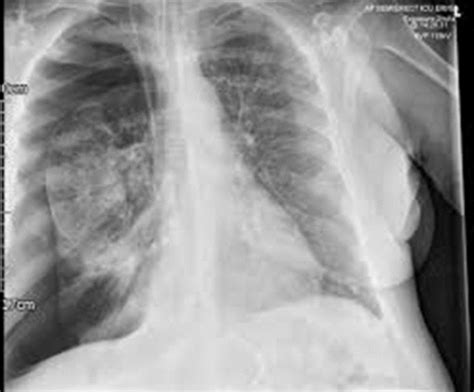 Pleural Disease Flashcards Quizlet