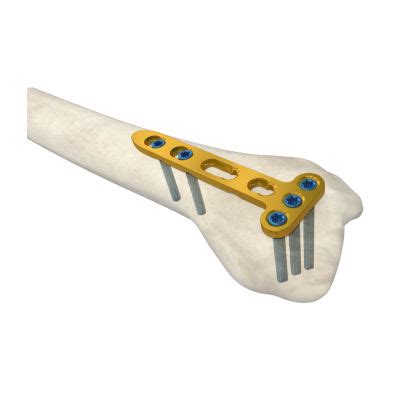 China Variable Angle Mm Acromioclavicular Hook Lcp Orthopedic Trauma