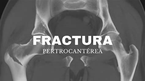 Fractura Pertrocant Rea Rehabilitaci N Tratamiento Y Tiempo De