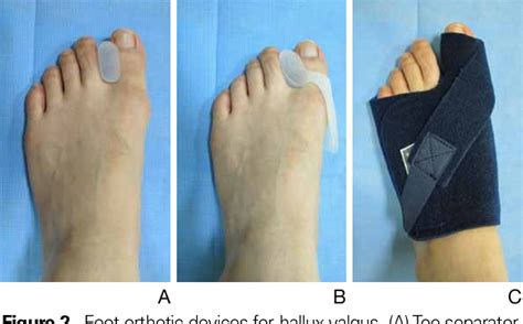 Hallux Valgus Treatment