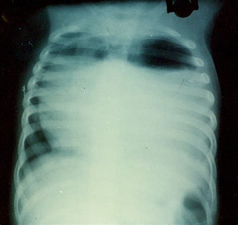 Pedi Cardiology Cxr Pericardial Effusion And After Partial