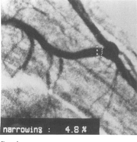 Figure From The Fully No Touch Technique For The Internal Thoracic