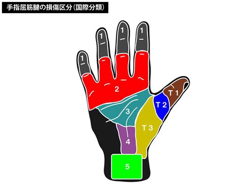 手指屈筋腱損傷のリハビリ治療