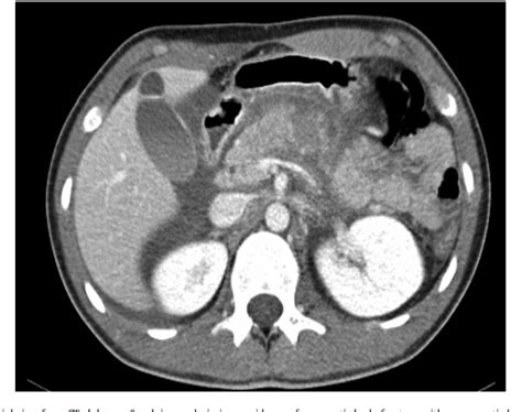 Figure 1 From Conservative Management Of Complete Traumatic Pancreatic