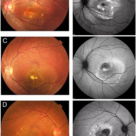 Fundus Photographs And Fundus Autofluorescence Faf Images Of The