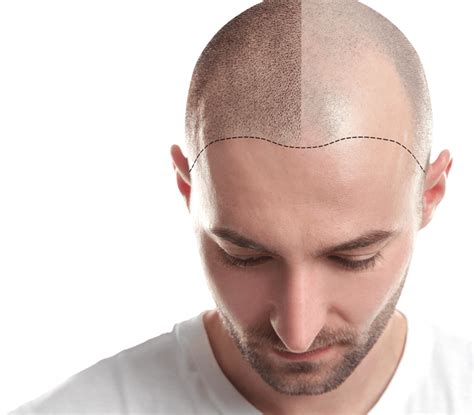 Hair Transplant In Ahmedabad Musk