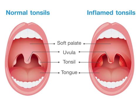 white spot on tonsils no pain Archives - Grind Your Soul