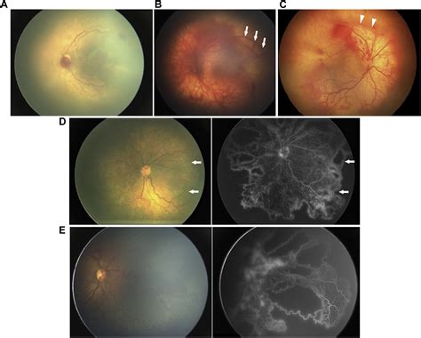 International Classification Of Retinopathy Of Prematurity Third