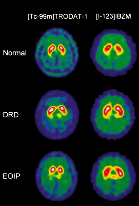 Clinical And [99mtc]trodat 1 [123i]ibzm Spect Imaging Findings In Dopa