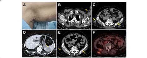 General Observation And Imaging Examinations A Subcutaneous Mass At