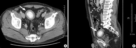 Abdominopelvic Computed Tomography Findings A Axial Image Shows A