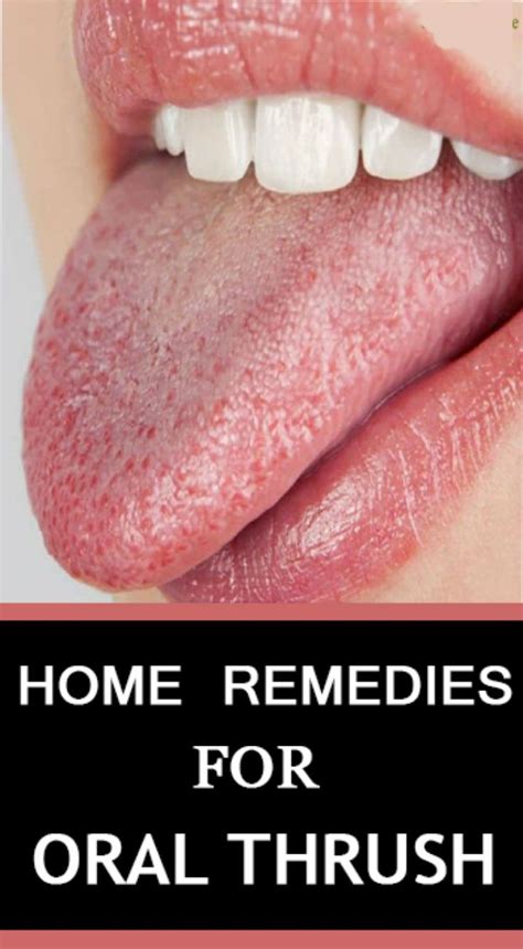 Home Remedies For Oral Thrush Lifestyle 365 Oral Thrush Remedies Home Remedies For Thrush