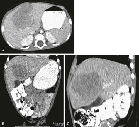 Malignant Tumors Of The Liver Radiology Key