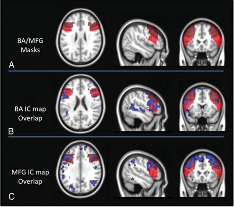 Figure 1 From Lateralization In Patients With Brain Tumors Middle