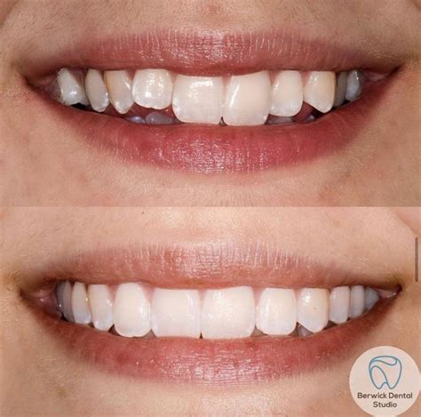 Another Amazing Transformation Created With Invisalign Berwick