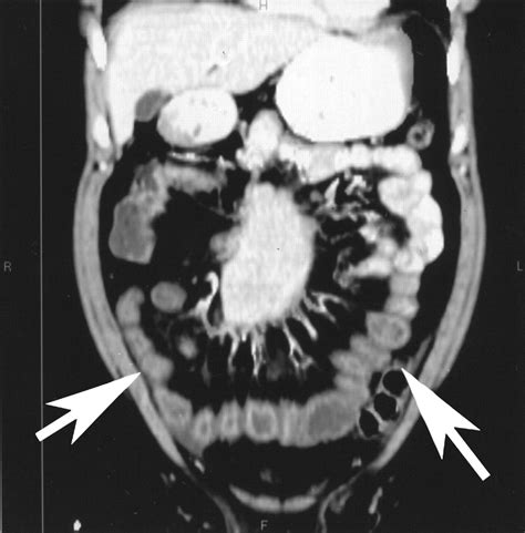 Carcinoid Tumors Of The Small Bowel A Multitechnique Imaging Approach