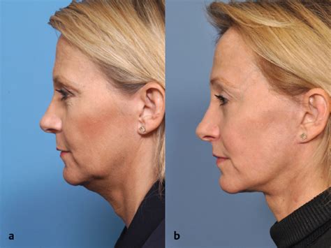 14 Rhytidectomy | Plastic Surgery Key