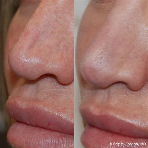 Eric M Joseph Md Permanent Non Surgical Rhinoplasty Nose Job