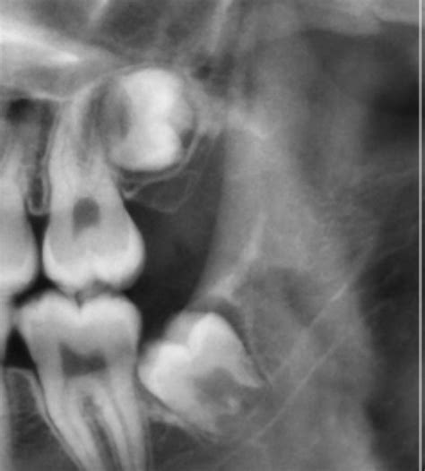 Has Anybody Seen A Wisdom Tooth Grow This Way And Does Anybody Know What It Would Be Called Ty