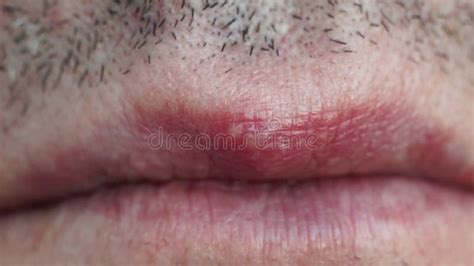 Herpes De Enfermedad Viral En El Labio De Un Hombre Almacen De Video