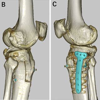 Postoperative Three Dimensional Computed Tomography After Medial