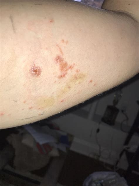 Normal Picc Line Rash After Removal Or A Recurrence Of Tick Rash It