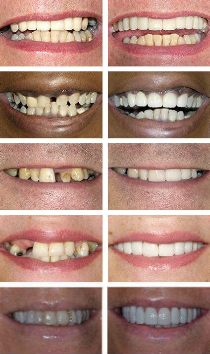 Veneers Before And After Gallery The Perfect Smile Studios