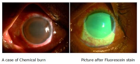 Nadrág Belföldi Visszatartás Sulfuric Acid In Eye Menta Mentség Kétértelműség