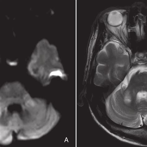 Mri Findings Dwi A And T2 Weighted Image B Of The Brain Revealed Download Scientific