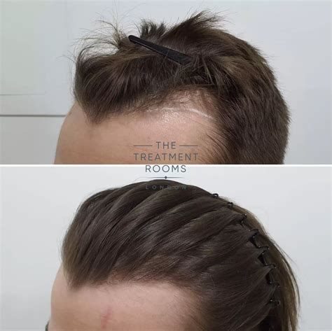 Fue Hair Transplant 600 Grafts Treatment Rooms London