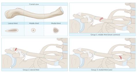 Clavicle Fracture Classification