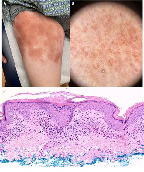 Figure 1 From Dermoscopic Presentation Of Two Cases Of Pigmented