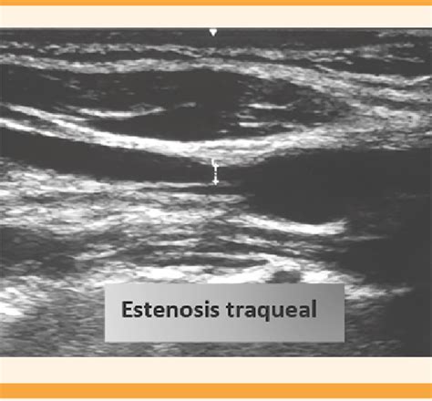 Ultrasonido de la tráquea donde se observa el grado de la estenosis