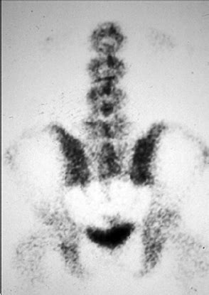 A Technetium M Methylene Diphosphonate Whole Body Bone Scan Reveals A