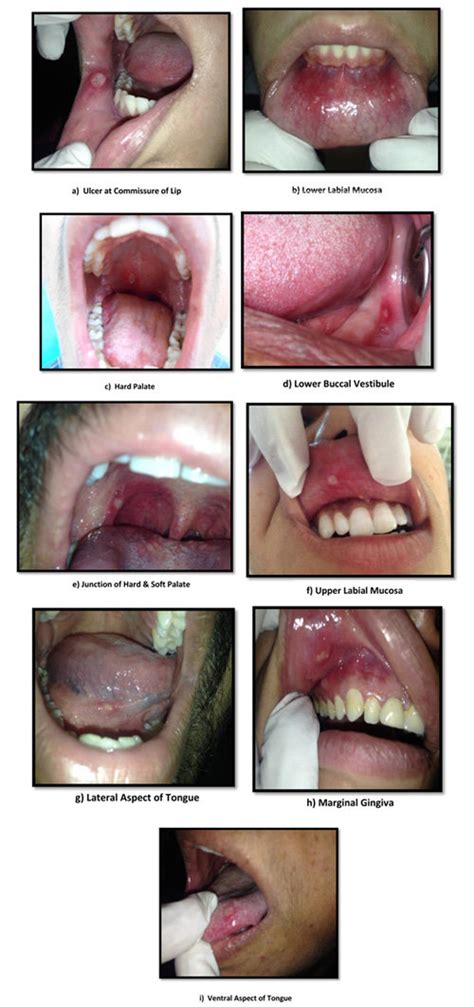 Different Sites Involved In Recurrent Aphthous Ulcers Download Scientific Diagram