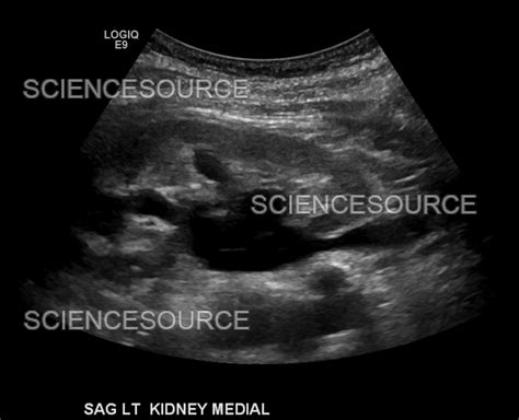 Photograph | Hydronephrosis, ultrasound | Science Source Images