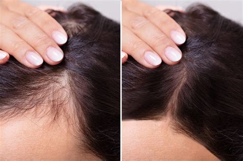 Fms Skin And Hair Female Pattern Baldness Symptoms And Treatments