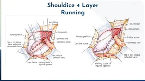 Inguinal Hernia Repair Shouldice