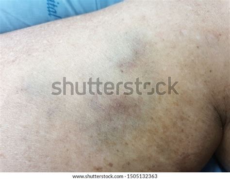 Skin Disease Lesion Ecchymosis Vasculitis Stockfoto