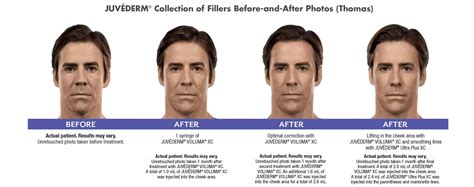 Enhance Your Beauty with Dermal Fillers | BlueMedCenter