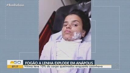 Jovem Tem Corpo Queimado Ap S Fog O A Lenha Explodir Enquanto Cozinhava