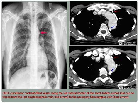 Chest Medicine Made Easy Dr Deepu Important Chest Radiology Signs