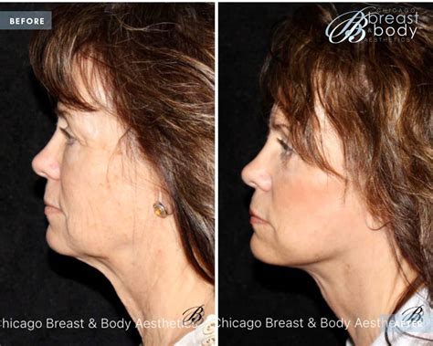 Scarless Neck Lift Facial Plastic Surgeon Years Experience