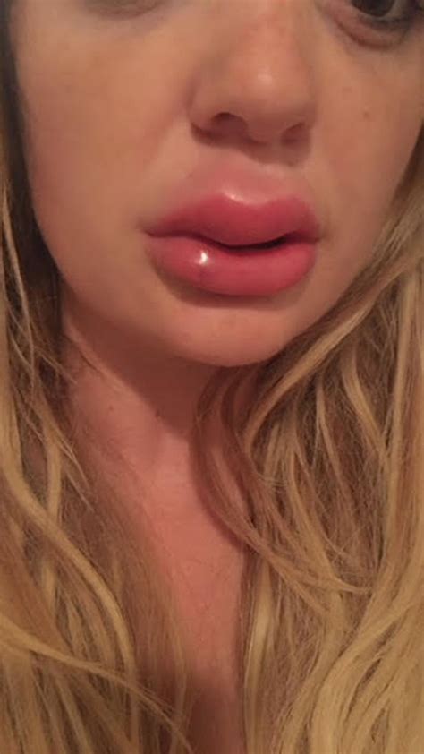 Swollen Upper Lip After Filler Sitelip Org