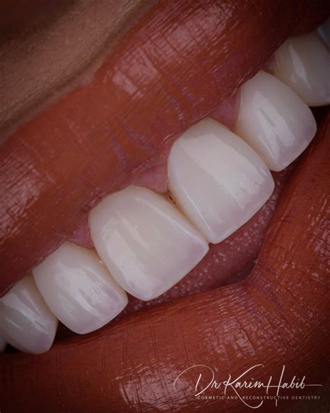 Composite Veneers Sydney Dental Bonding Sydney Dentist Ryde