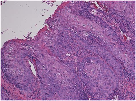 A Primary Intraosseous Squamous Cell Carcinoma Case Report And