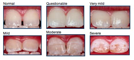 DENTAL FLUOROSIS - WOW DENTAL